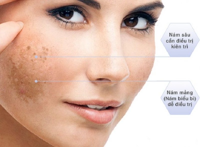 Nám da có thể xuất phát từ yếu tố bên trong hoặc bị ảnh hưởng bởi yếu tố bên ngoài