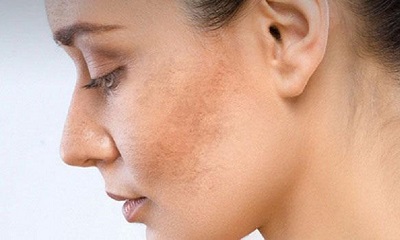 Nám da là gì? Nguyên nhân và cách điều trị nám da mặt