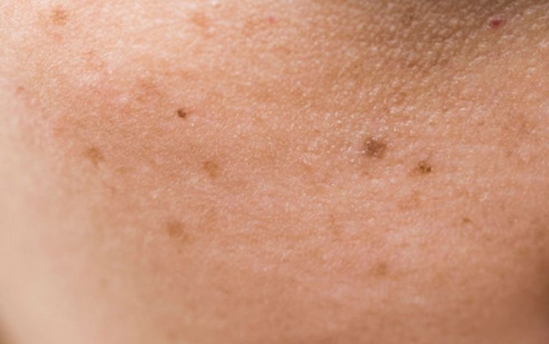 Biểu hiện của tình trạng này là những đốm nâu hoặc đen trên da và ngày càng có xu hướng lan rộng