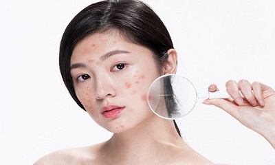 Các cách chăm sóc da mặt mụn hiệu quả