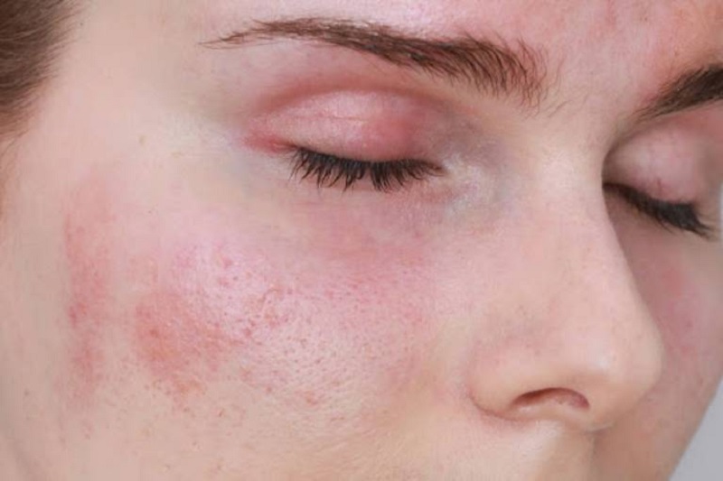 Tình trạng da khô tróc vảy có thể xuất hiện do bị viêm da tiếp xúc