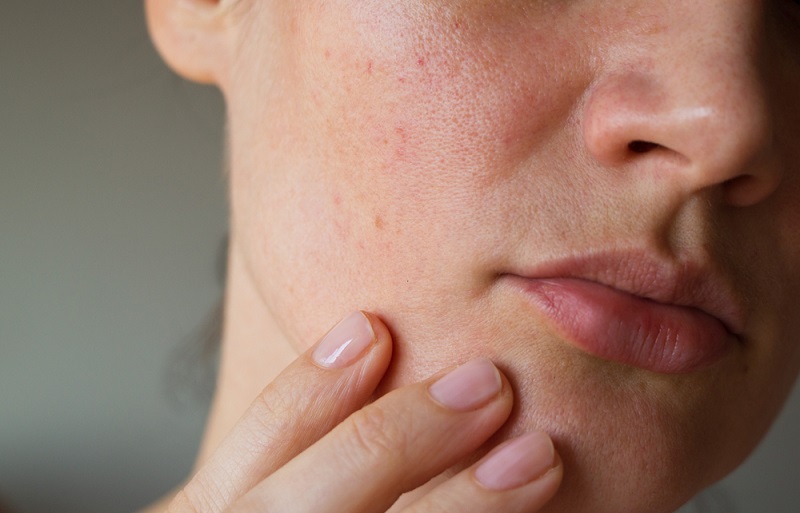 Da bị tróc vảy trắng và ngứa là hiện tượng điển hình ở những người có làn da khô nghiêm trọng