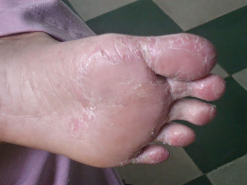 Da chân bị bong tróc thường là tổn thương lành tính, không quá nguy hiểm tới người bệnh