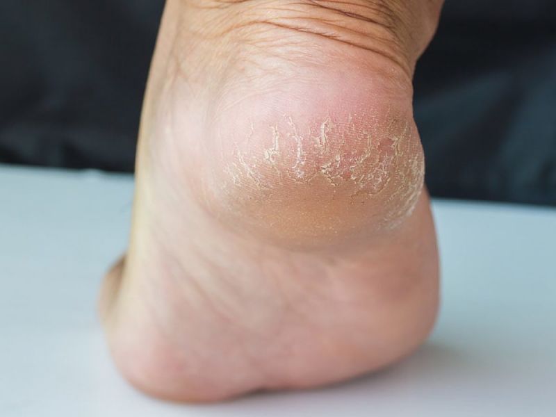 Da chân khô sần có thể gây ngứa và chảy máu