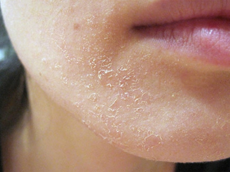 Da mặt khô rát sần sùi là tình trạng rất thường gặp, nhất là khi thời tiết chuyển mùa hanh khô