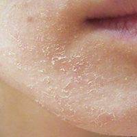 Da mặt bị khô sần phải làm sao? Những gợi ý cần biết