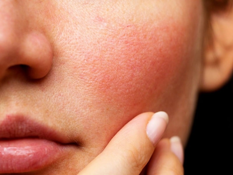 Nẻ da mặt là hiện tượng da mặt bị thiếu nước một cách nghiêm trọng