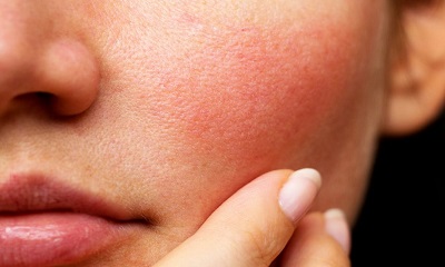 Nẻ da mặt là hiện tượng rất thường gặp vào mùa đông