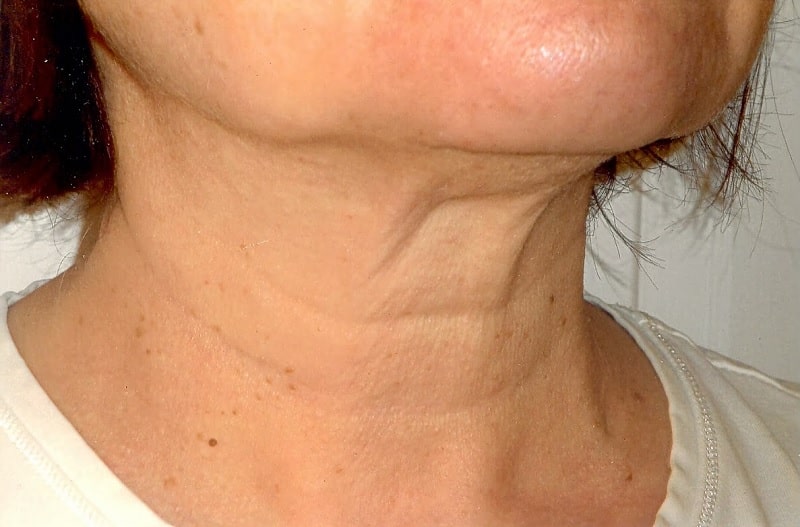 Các dấu hiệu lão hóa da thường dễ dàng nhận thấy ở vùng cổ