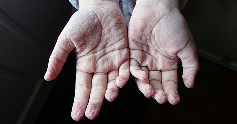 Tình trạng da tay nhăn nheo thường xuất hiện do nhiều nguyên nhân