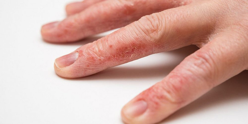 Trong một số trường hợp da bị nhăn nheo có thể là dấu hiệu của viêm da