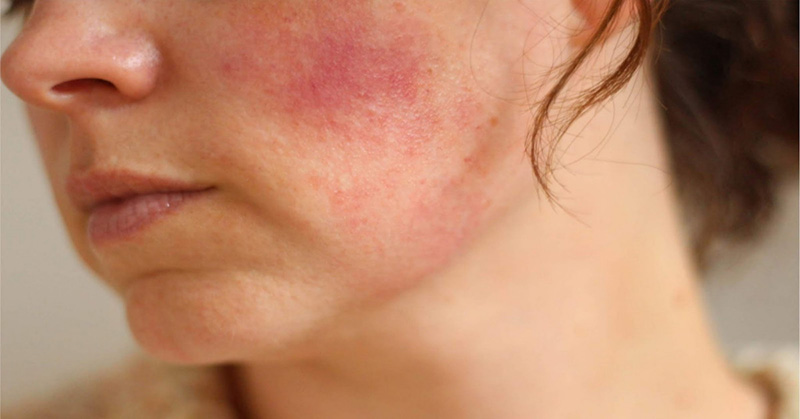 Dấu hiệu dị ứng thường xuất hiện ngay sau khi da tiếp xúc với mỹ phẩm
