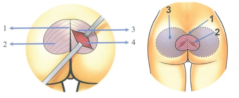 Nâng mông nội soi thực chất là biện pháp phẫu thuật chèn miếng độn mông trong cơ thể