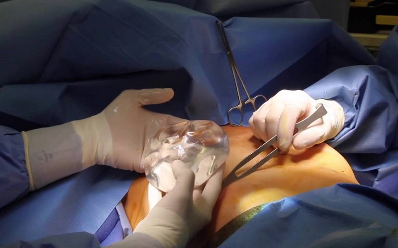 Phẫu thuật nâng ngực chảy xệ dùng túi độn