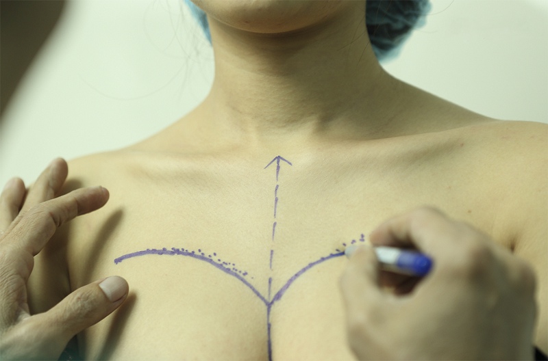 Phương pháp nâng ngực nội soi mang đến hiệu quả lâu dài