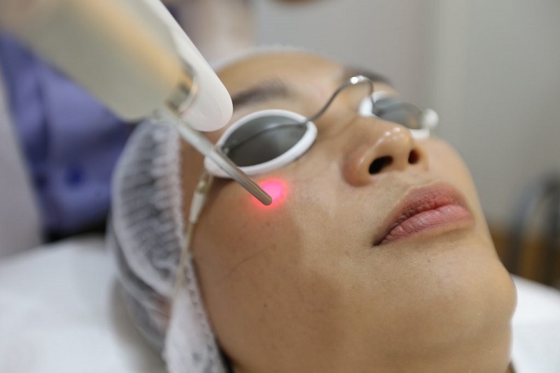 Công nghệ Acne Removal Laser trị mụn 