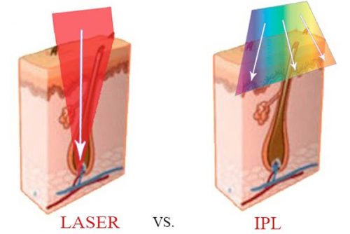 Công nghệ trị nám IPL ưu việt hơn Laser