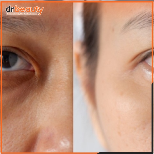 Hình ảnh Trước - sau của chị Thanh Mai sau liệu trình trị thâm mắt bằng laser