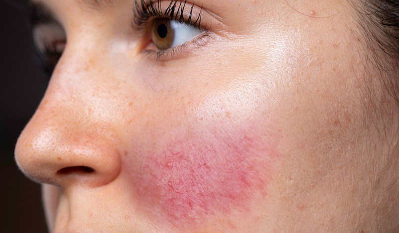 Làn da có thể bị sưng đỏ hoặc ngứa ngáy sau điều trị