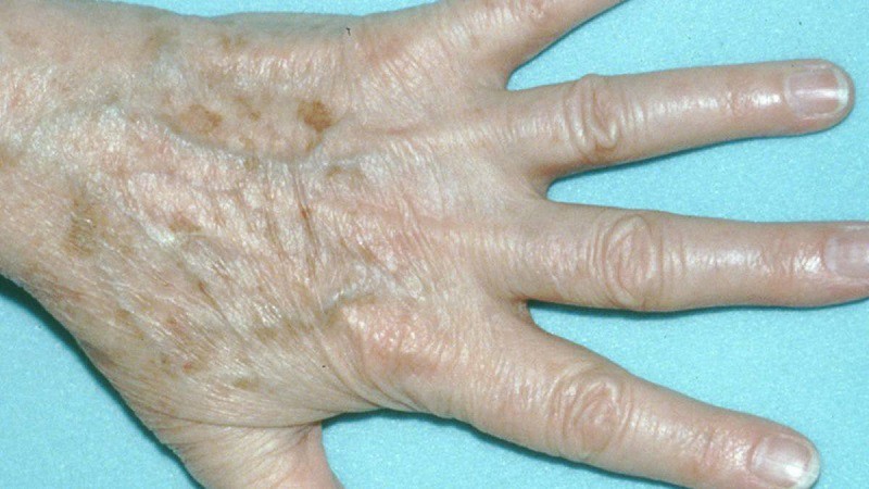 Khi bị tàn nhang ở tay, làn da sẽ xuất hiện các đốm màu nâu