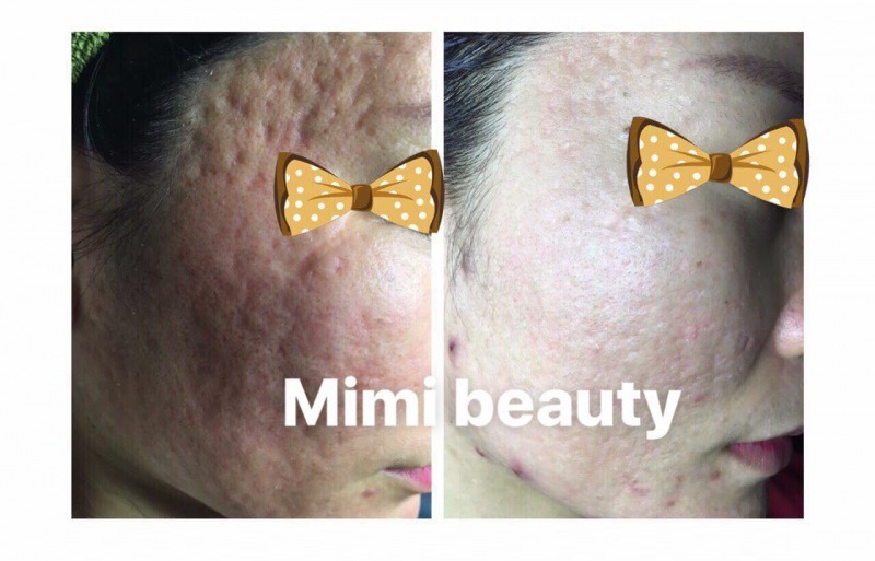 MiMi Beauty & Clinic là địa chỉ trị sẹo rỗ Nha Trang uy tín