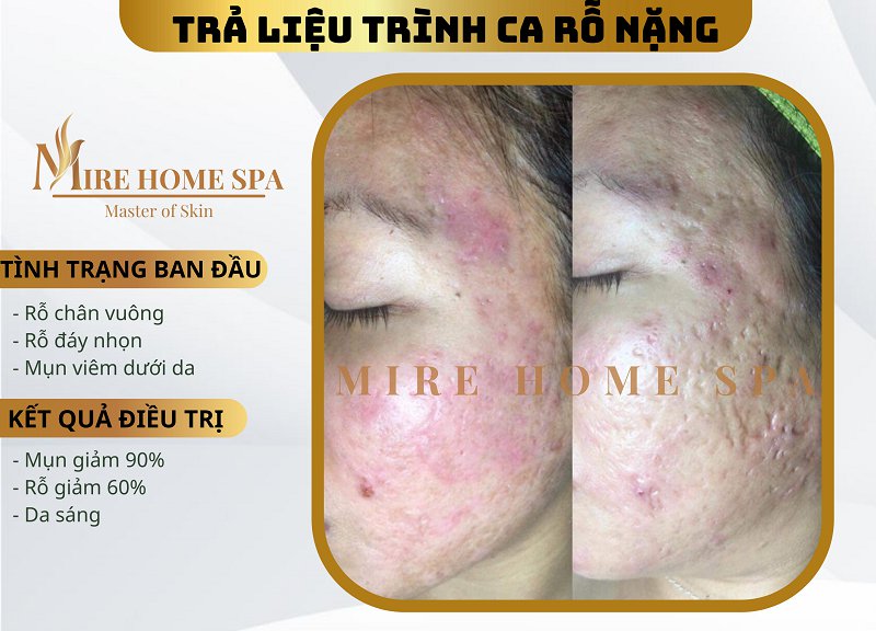 MiRe Home Spa được nhiều người lựa chọn để trị sẹo rỗ ở Nha Trang