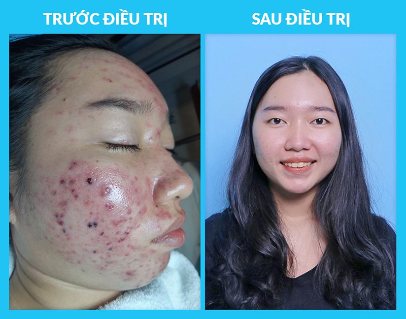 Trước và sau khi trị sẹo tại phòng khám chuyên khoa Da liễu O2 Skin