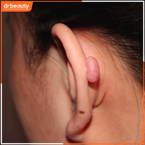 Một số dấu hiệu nhận biết sẹo lồi ở tai