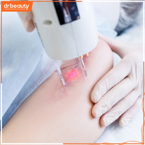 Xóa sẹo bằng laser có thể áp dụng với cả những làn da nhạy cảm nhất