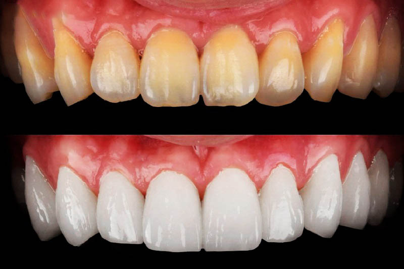 Phương pháp bọc răng sứ được các chuyên gia đầu ngành đánh giá cao 