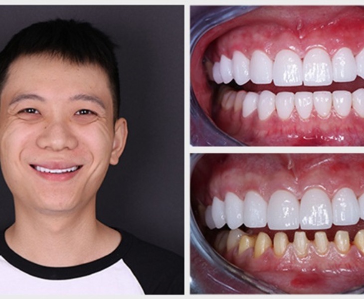 Kết quả sau khi khách hàng sử dụng dịch vụ bọc răng sứ tại ViDental Clinic