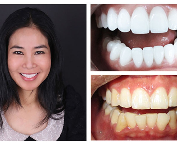Khách hàng đánh giá cao về dịch vụ bọc răng sứ của ViDetal Clinic
