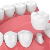 Review Bọc Răng Sứ Tại ViDental Clinic Từ Khách Hàng Và Chuyên Gia Đầu Ngành
